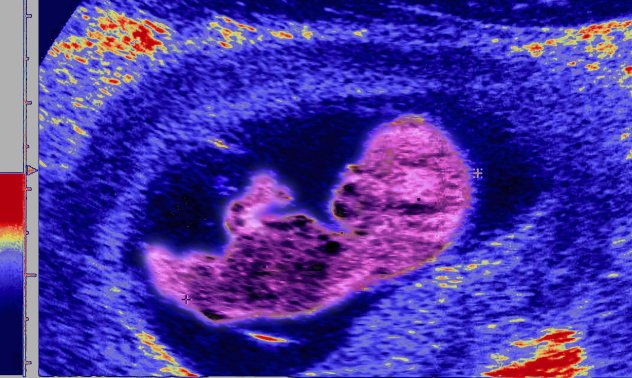 Ин витро законите в Хонконг създават процъфтяващ черен пазар за яйцеклетки и ембриони